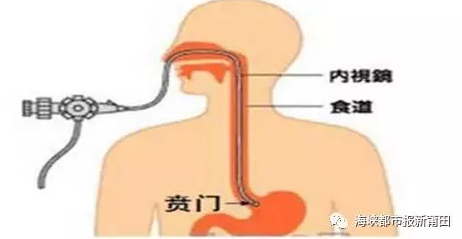 贲门癌发病,正呈年轻化趋势