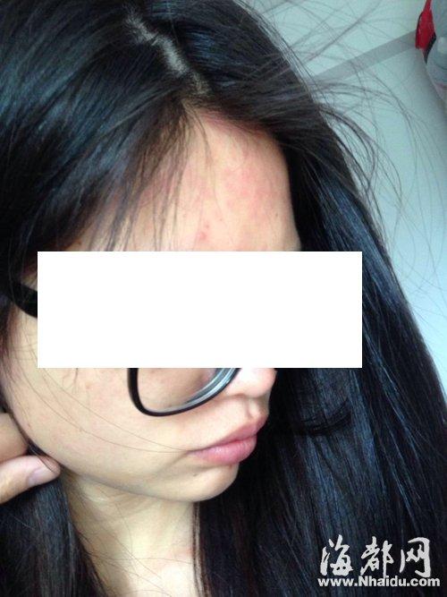 <em>少女月经过少</em>被查妇科全套 药不对症全身过敏