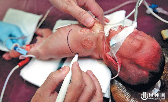 全省最小先天性心脏病患者1.3公斤宝宝成功手术