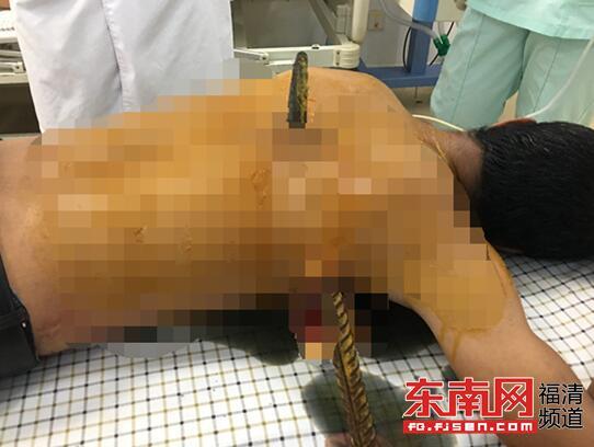福州一男子拆除建筑模板时被撬棍穿透身体