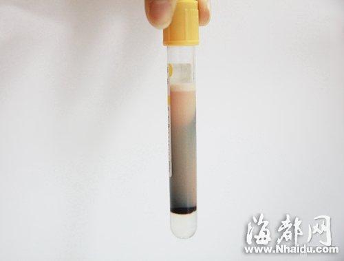 小刘抽出的血静置后呈乳白色,都是"油脂"