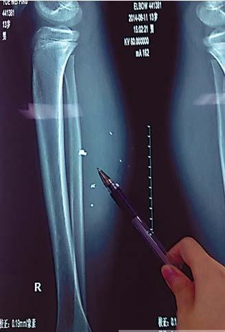 男孩充电玩游戏不注意 手机爆炸致异物进入小