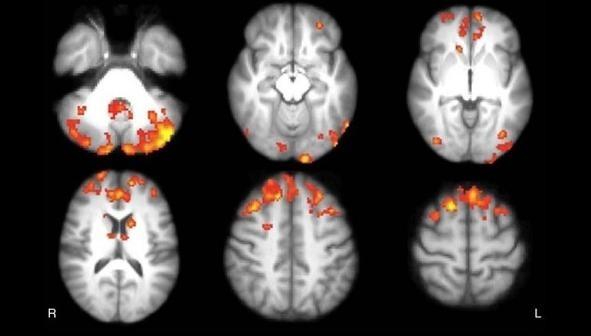 最新科研成果:玩电脑游戏能治疗脑部疾病