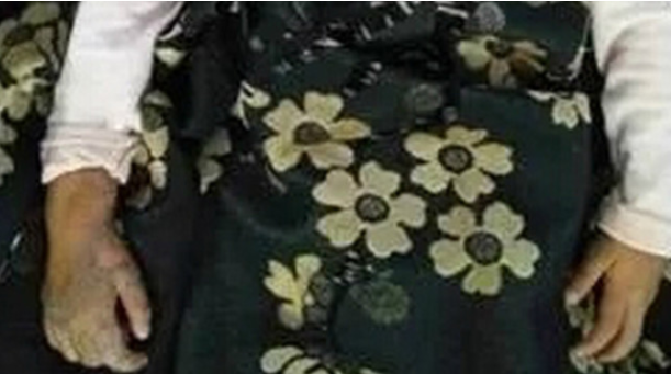 可怕！東莞一女童被氣球炸傷 右手一層表皮直接炸撕