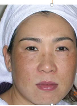 问题皮肤分类标准及治疗标准