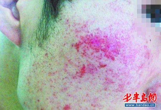 屈臣氏购薇婷脱毛膏致面部过敏 布满红疙瘩