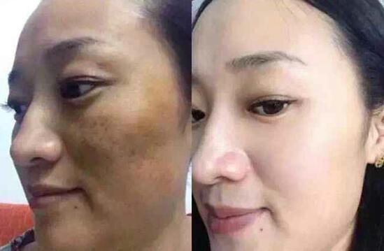 最有效的祛斑土方法有哪些 什么祛斑好