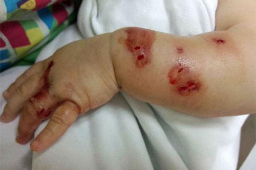 咬致血肉模糊    转播到腾讯微博 日前,一名两个月大的女婴被老鼠咬伤