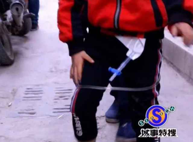 8歲女孩隨身攜尿袋 跟父親廣州街頭乞討