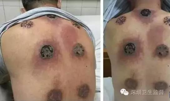 四川省一名63岁的李大爷因为患有肩周炎,所以天天都会去拔火罐.