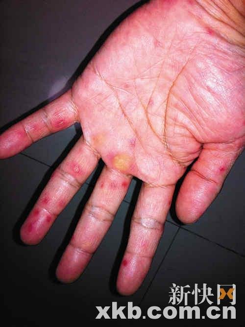 广州一幼儿园3幼童患手足口病 家长照顾被传染