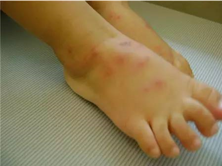 6岁女娃全身发痒 脸红眼肿住进监护室,只因被蚂蚁咬了