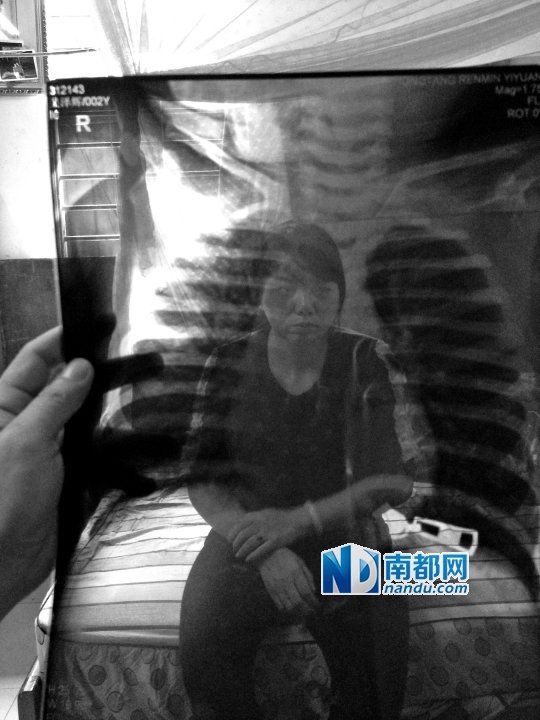 东莞一岁半男童吃花生米被噎死 专家支招