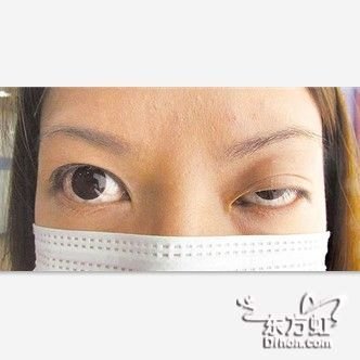 台湾女子婚前变大小眼 都是肉毒素惹的祸