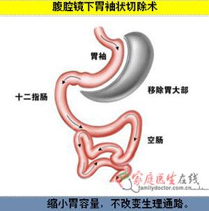 减重手术全揭秘:不是每个胖子都适合做