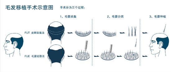 毛囊分离,毛囊种植
