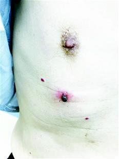 宜昌大爷菜园遭蜱虫群攻 预防蜱虫叮咬这些要