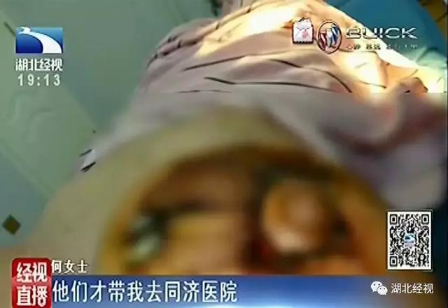 女子花16万丰胸和隆鼻术后胸部出现溃烂化脓