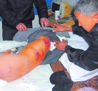 受害男童背部伤痕累累.