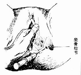 图解分娩时会阴侧切手术全过程_健康频道_妈