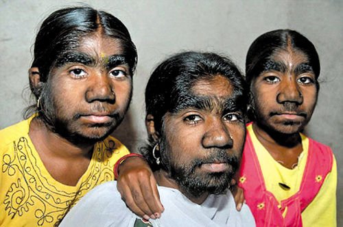 印度三姐妹患狼人综合征 盼爱情愁嫁人