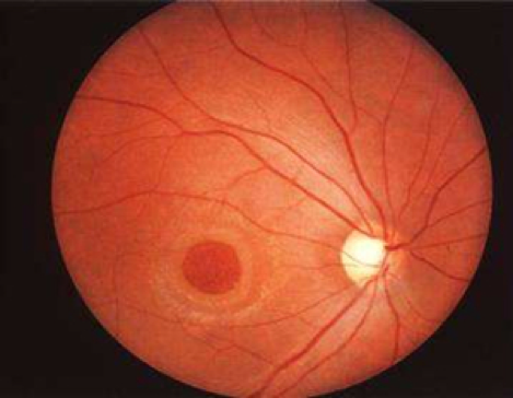 什么是孔源性视网膜脱离?_大楚网_腾讯网
