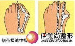 金志福教授:脚拇指外翻畸形微创矫正术