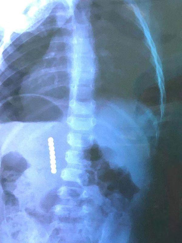 幼童误食磁力珠险丢命 专家:警惕玩具安全隐患