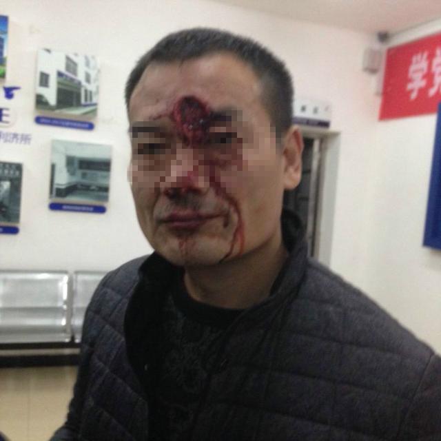 男子打的发酒疯连咬两人 将路人额头咬出一个坑_大楚网_腾讯网