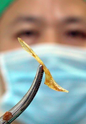 鱼刺扎手指会引发骨髓炎 不及时取出或将截肢