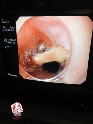 老人喝汤贴秋膘 误吞异物隐忍一周食管险穿孔