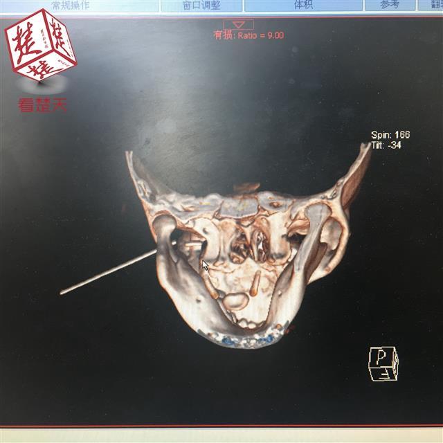 近日,一名脸上插着铅笔的女童,被送到武汉儿童医院急诊,画面惊悚,让