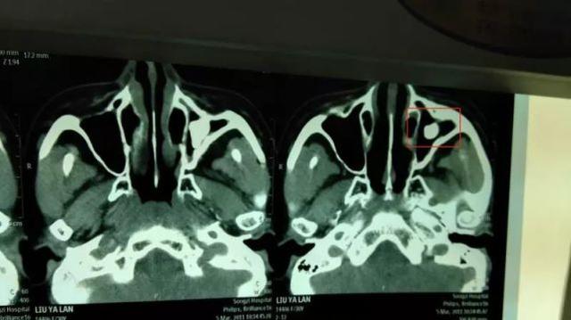 武汉一女士鼻孔里长出牙齿 8年来鼻塞流涕不断
