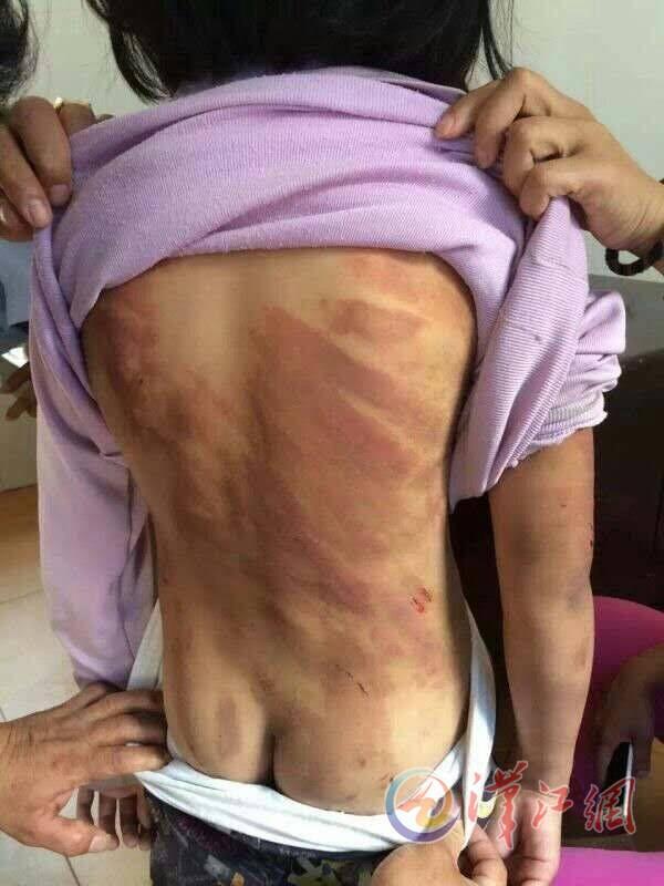 襄阳女孩遭继母虐待 吃不饱饭且全身伤痕累累_大楚网_腾讯网