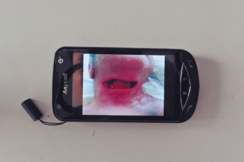 未满月女婴遭割喉遗弃 伤口8厘米深达气管