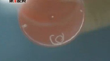 三岁男童眼睛里长了三条活虫 最长有两厘米_教