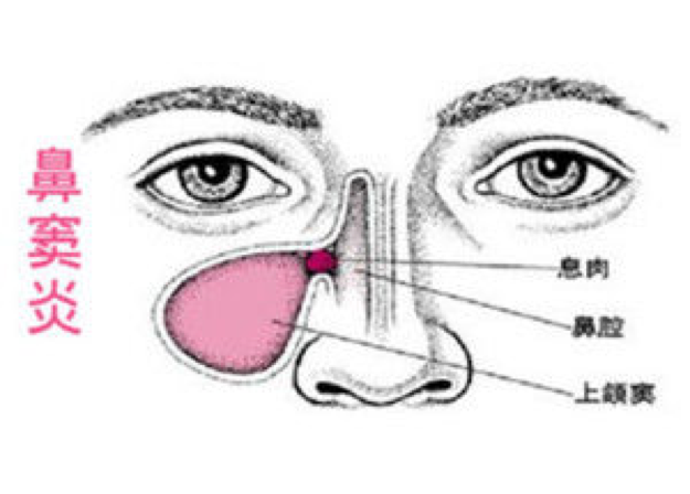 鼻窦炎早期症状知多少 头痛鼻塞流鼻涕需注意
