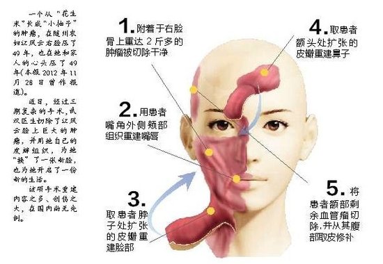 随州49岁农妇在汉换脸 切下2斤肿瘤系国内首例