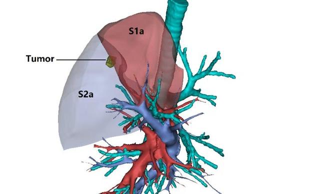 荆门一医开展3D技术+微创精准肺段切除术