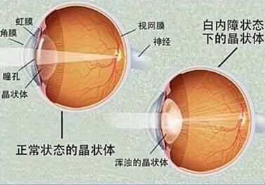 每个人都可能会得白内障?专家这样解释