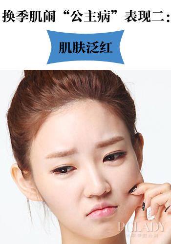 摆脱干痒敏感 拯救换季肌肤3大公主病