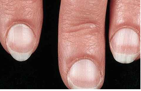 指甲变化提示十种健康疾病