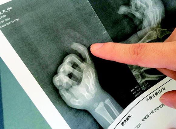 荆州电梯吞人事件后 武汉电梯投诉增多