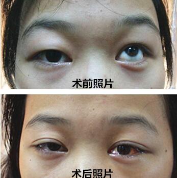 大二女生左眼上斜 艾格眼科成功手术拔正眼位