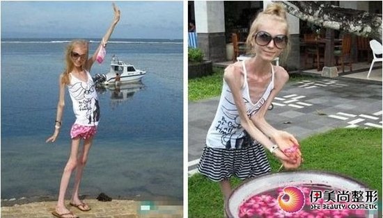 从20公斤的俄罗斯少女看科学减肥