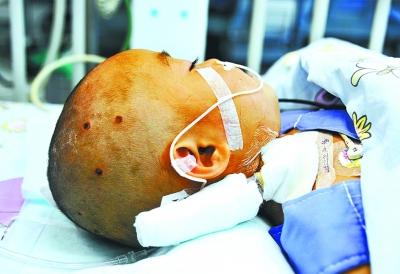 2岁宝宝被胡蜂蜇伤换血保命 头顶有7个被蜇伤口