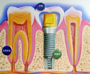 在武汉种一颗牙齿大概需要多少钱?_大楚网_腾
