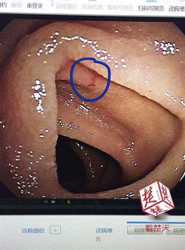 近年来反复出现解黑便,重度贫血,需要依靠定期输血才能维持正常生活