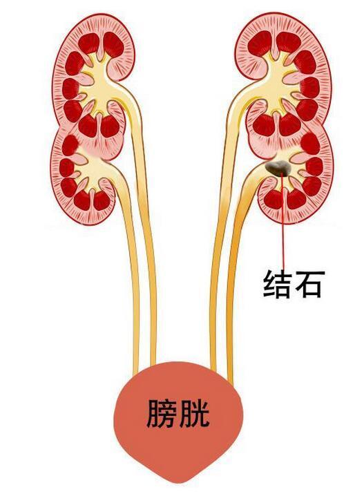 湖北一女子长了四个肾 有种功能远超常人(图)