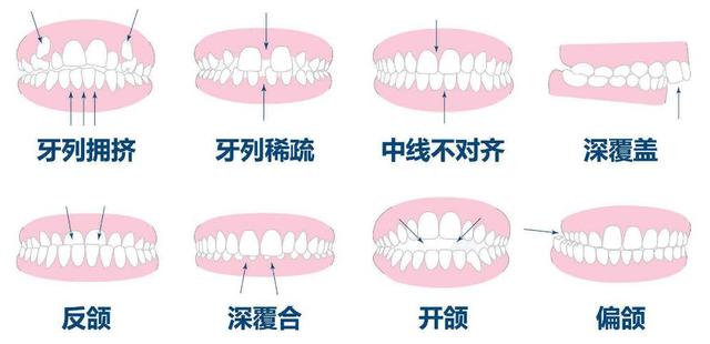 成年人牙齿不齐怎么矫正